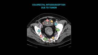 17⏰️COLORECTAL INTUSSUSCEPTION DUE TO TUMOR 👉Coronal and axial CT images🌺 [upl. by Viole]