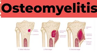 Osteomyelitis  Causes Sign and Symptoms Diagnosis amp Treatment Pathology [upl. by Nellir743]