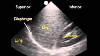 How To Ultrasound Detection of Pleural Fluid Case Study Video [upl. by Matthew]