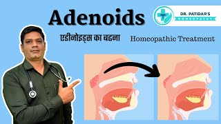 Adenoids Homeopathic Treatment  एडीनोइड्स का बढना  Dr Sunil Patidar [upl. by Essilrahc]