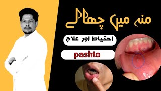 Da Holee 👄 Zaham • Pashto  منہ میں چھالے Apthous Ulcer  Canker sore  Dr Asif [upl. by Esirehs]