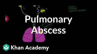 Pulmonary abscess  Respiratory system diseases  NCLEXRN  Khan Academy [upl. by Caspar]