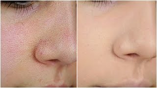 الطريقة الصحيحة لاخفاء المسام المفتوحة و شوائب البشرة نهائيا  How to Cover Up Large Pores [upl. by Anhej]