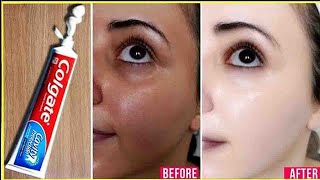 Apply Toothpaste on Your Skin and See Magical Result within 1 Hour  Amazing Toothpaste Beauty Hacks [upl. by Donelu]