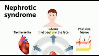 Nephrotic Syndrome  MEDICINE Lectures  NEPHROLOGY  TP 8 [upl. by Irec]