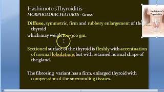 Pathology 811 b Hashimoto Thyroiditis inflammation Thyroid Lymphocytic Microscopy Hurthle Cell CTLA4 [upl. by Nerrawed882]