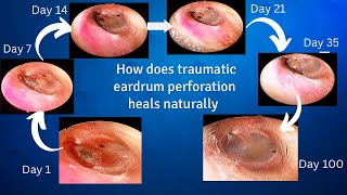 How does traumatic eardrum perforation heals [upl. by O'Callaghan]