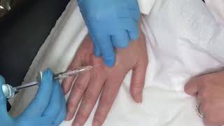 How to have younger looking hands with a Skin Booster Treatment [upl. by Atiuqrahc]