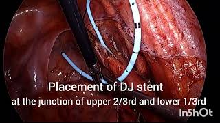 LAPAROSCOPIC URETEROLITHOTOMY FOR LOWER URETERIC STONE [upl. by Suoilenroc]