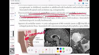 chiari 2 malformation neurology 8  First Aid USMLE Step 1 in UrduHindi [upl. by Gwenora]