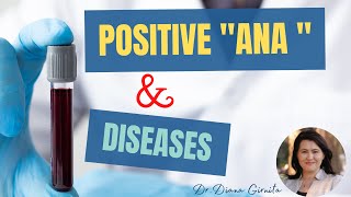 Positive ANA test antinuclear antibodies and autoimmune diseases [upl. by Hurty]