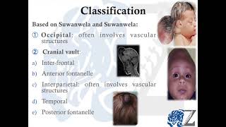 Encephalocele كيس الدماغ [upl. by Rora]