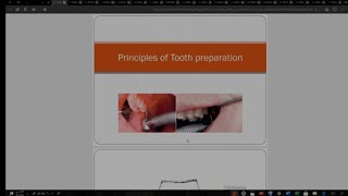 🔴 بثًا مباشرًا شرح fixprostho part 2tمن ✨metalceramic crown preparation ✨دكتور علاء الزريقي 💫 [upl. by Horwath]