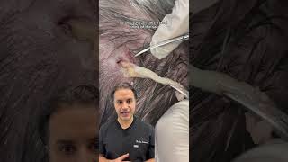 DR SOLOMON explains the removal of epidermoid cyst  DR MEDISPA [upl. by Aleron]