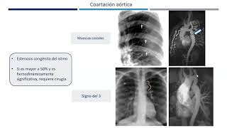 Patología cardiovascular Parte II Radiología aortica [upl. by Eelinej853]