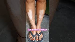 Vitiligo healthtipsinhindi dermatology skindiseases skin charmrog [upl. by Nahtonoj260]