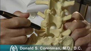 Isthmic Spondylolisthesis Video  Stress Fracture of the Back Vertebra  Spine Surgeon Colorado [upl. by Auhesoj]