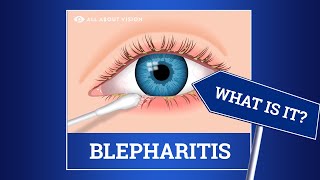 Blepharitis red swollen eyelids Causes Symptoms Treatments [upl. by Dyana]