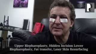 2 Male Blepharoplasty Eyelid Lift Video Diary Four hours after Surgery [upl. by Kurman]