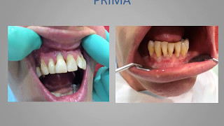 Impianti dentali prima e dopo Impianti dentali Chirurgia implantare [upl. by Hsivat640]