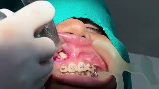 Surgical removal of Labially Impacted Maxillary Canine [upl. by Odom]