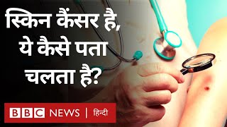 Skin cancer  स्किन कैंसर का लक्षण बचाव और इलाज जानिए BBC Hindi [upl. by Cha187]