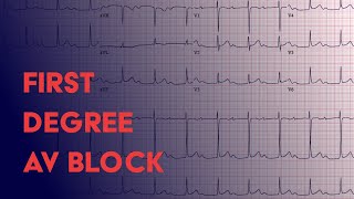 First Degree AV Block  EKG ECG Interpretation [upl. by Dannica]