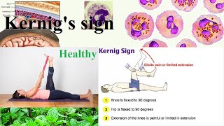 Kernigs sign [upl. by Ancilin50]