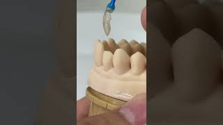 Thin veneer for no prep teeth EnvisiontecMain envisiontec [upl. by Buyers]