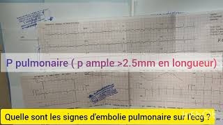 QUELLE SONT LES SIGNES DEMBOLIE PULMONAIRE SUR LECG CAS PRATIQUE [upl. by Ibson254]