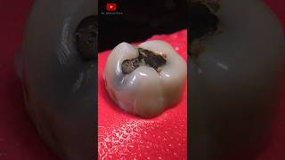 Restauración dental tipo inlay satisfying [upl. by Etteval]