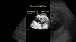 Anencephaly Fetus [upl. by Senaj914]