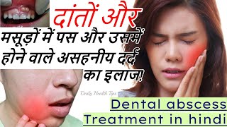 दांत में पस का इलाज  Dental abscess Treatment in hindi Masudo mein pas ka ilaj [upl. by Gaby879]