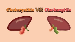 Difference between Cholangitis and Cholecytitis [upl. by Acilef613]