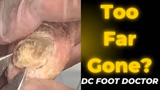 Too Far Gone Severe Fungal Toenails [upl. by Inan]