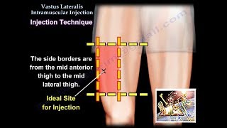 Vastus Lateralis Intramuscular Injection  Everything You Need To Know  Dr Nabil Ebraheim [upl. by Aihsei]