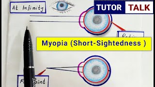 What is Myopia  Short Sightedness  Defects of eye class 10  Causes  Correction [upl. by Niple]