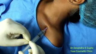 Devendras Infraclavicular Pediatric Brachial block [upl. by Lerak]