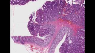 Histopathology Colon Tubular adenoma adenomatous polyp [upl. by Honna5]