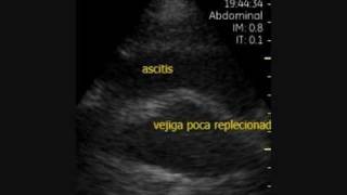 Vscan Ascitis y cirrosis hepatica [upl. by Rosmunda435]