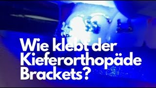 Wie klebt Dein Kieferorthopäde die Brackets auf die Zähne kieferorthopäde [upl. by Herries13]