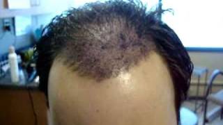 FUE and Strip Hair Transplant specialists SMG patient Nat  Dr Ron Shapiro Surgery [upl. by Immak]