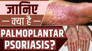 Palmoplantar Psoriasis के लक्षण और इसके उपचार  Psoriasis Specialist Care PsoriasisCareSpecialists [upl. by Reviel]