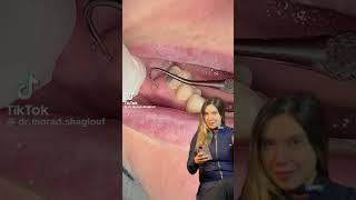 Abscesso na boca 😮 dentista odontologia abcesso [upl. by Tudor]