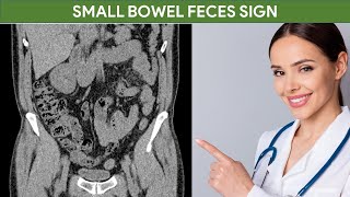 Small Bowel Feces Sign  Small Bowel Obstruction  CT Abdomen [upl. by Chivers]