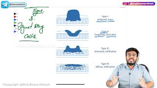 10 Gastric tumours  Benign and Malignant   USMLE Step 1 Pathology [upl. by Celeste]