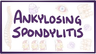 Ankylosing spondylitis  causes symptoms diagnosis treatment pathology [upl. by Enohpets]