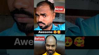 Awesome Result 😍🥰 Before And After journey hairtransplant hairtransformation D2LifeVlogging [upl. by Orson226]