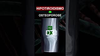 HIPOTIROIDISMO  OSTEOPOROSE [upl. by Suoivatram898]