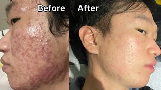 before and after Isotretinoinaccutane for 1 month straight Isotretinoinaccutane journey [upl. by Marcellina]